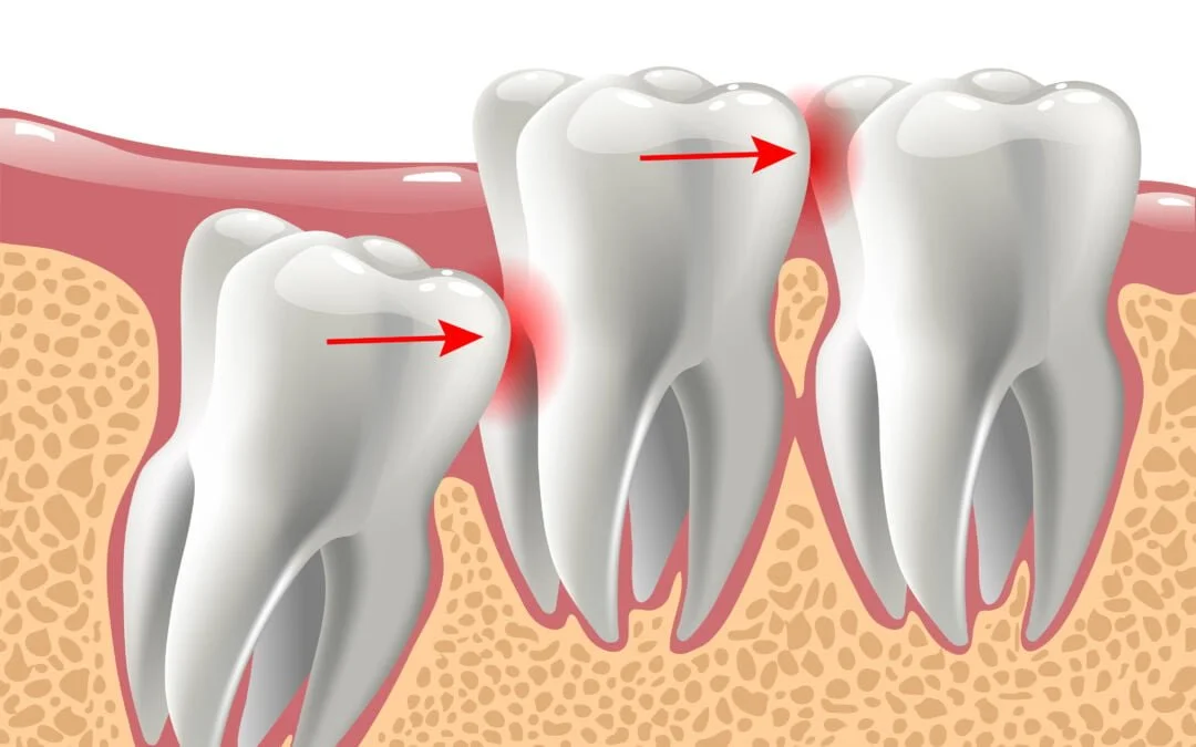 Wisdom Teeth: Understanding The Associated Risks