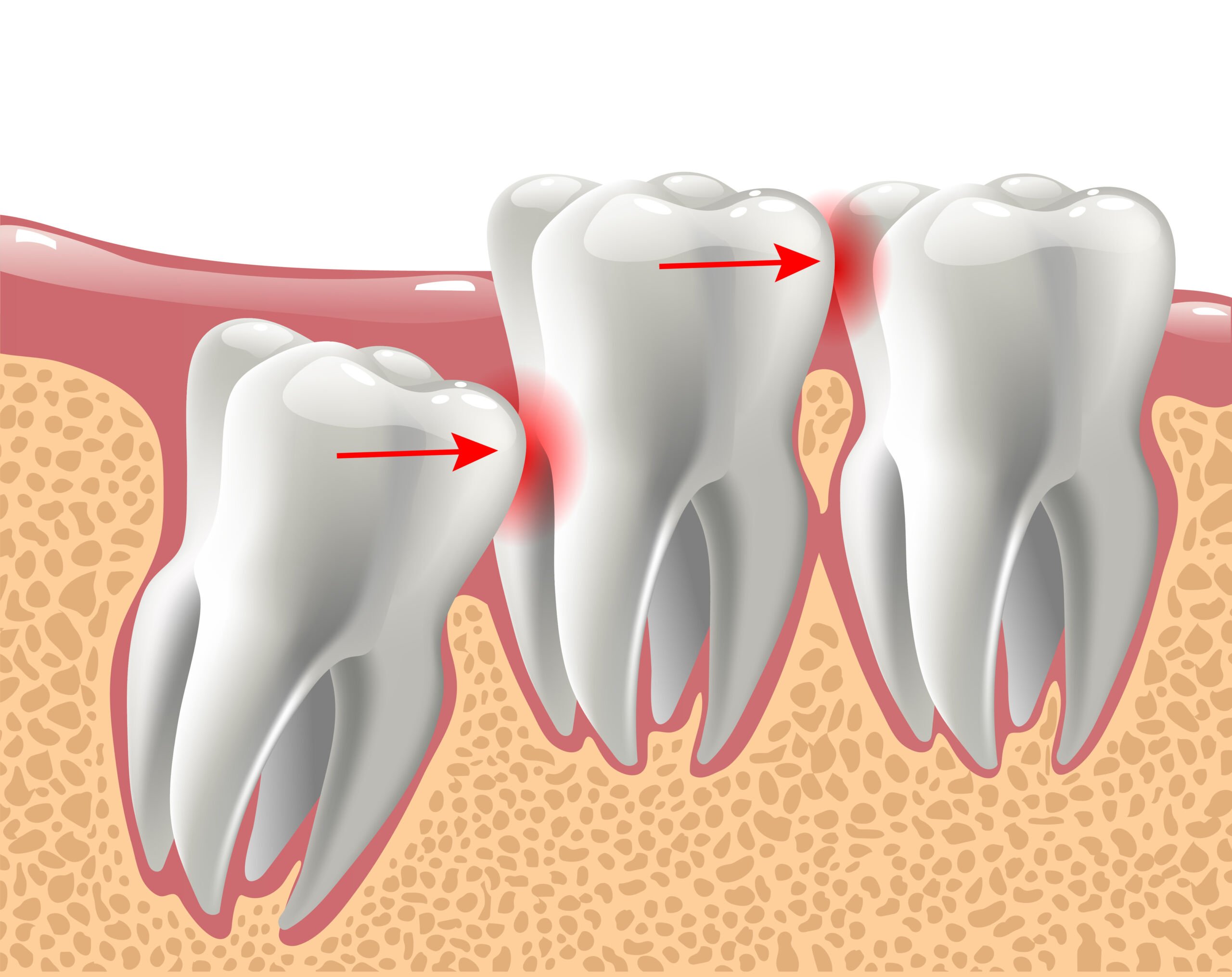 Wisdom Teeth Understanding The Associated Risks Maxillo 3 Lacs