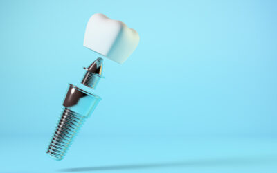 Can You Get Dental Implants with Bone Loss?