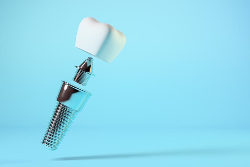 Can You Get Dental Implants with Bone Loss?