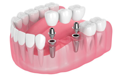 Step-by-Step Guide to Getting Dental Implants