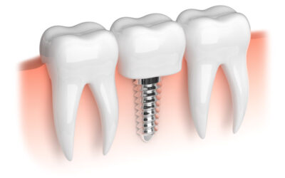 How to Prepare for Dental Implants This Fall